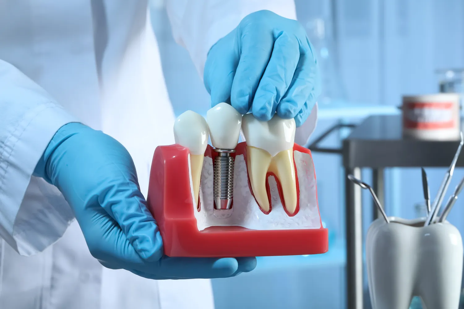 Jak wygląda zabieg wszczepiania implantów zębowych?